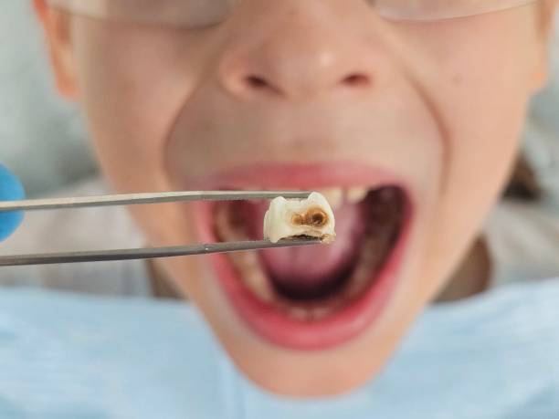 Best Same-Day Emergency Dental Services in Lapel, IN